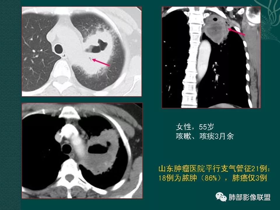影像PPT - 【PPT】空洞型肺癌的影像诊断及鉴别-24