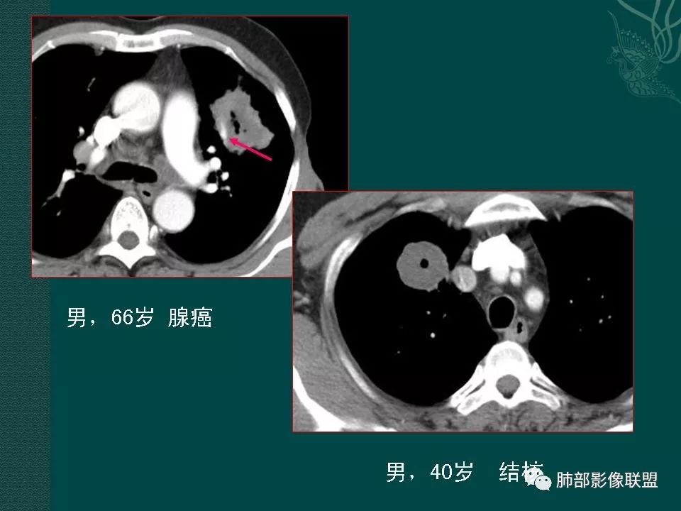 影像PPT - 【PPT】空洞型肺癌的影像诊断及鉴别-28
