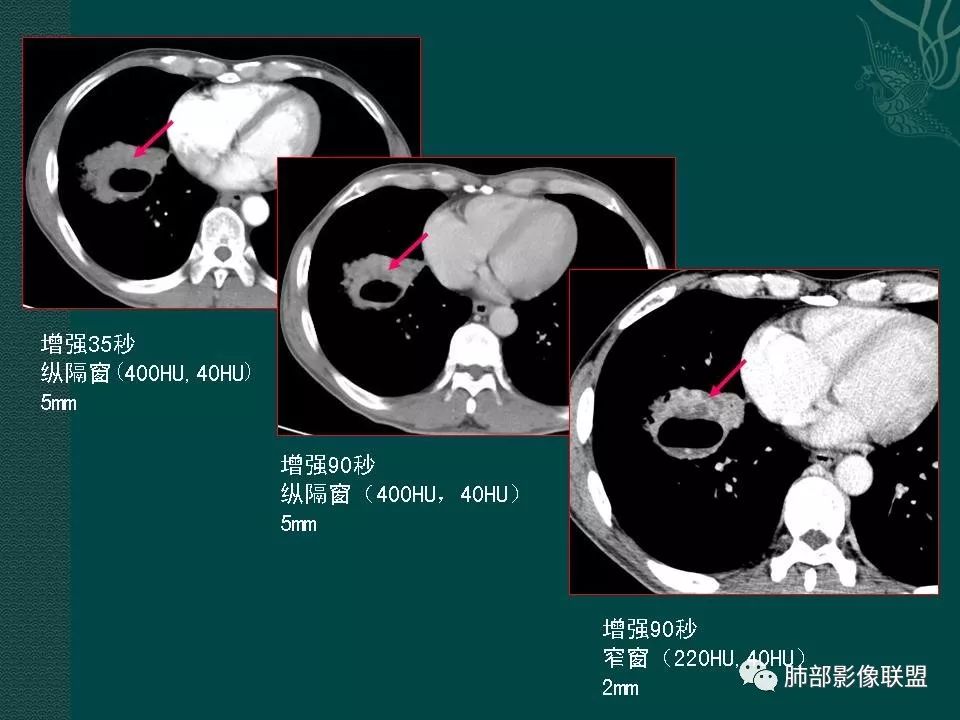 影像PPT - 【PPT】空洞型肺癌的影像诊断及鉴别-32