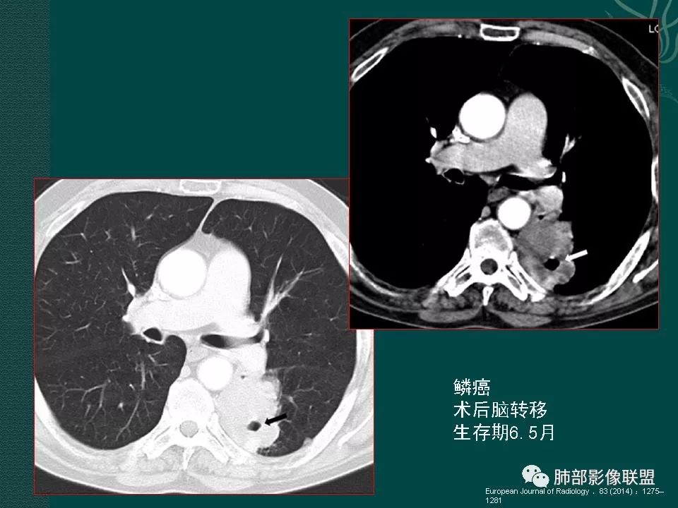 影像PPT - 【PPT】空洞型肺癌的影像诊断及鉴别-37