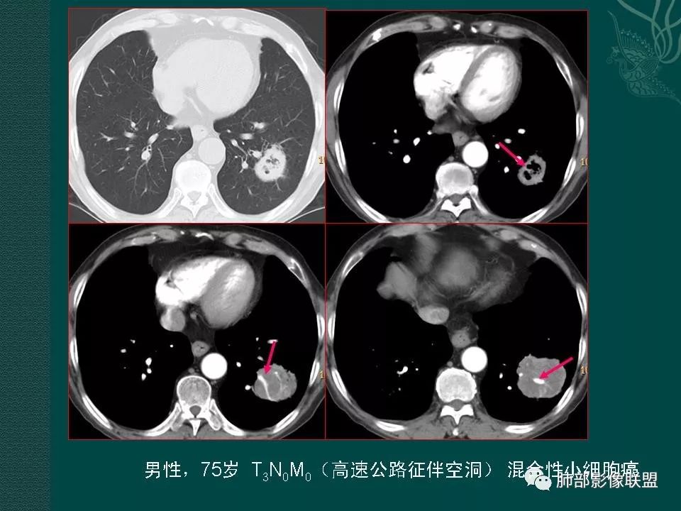 影像PPT - 【PPT】空洞型肺癌的影像诊断及鉴别-35