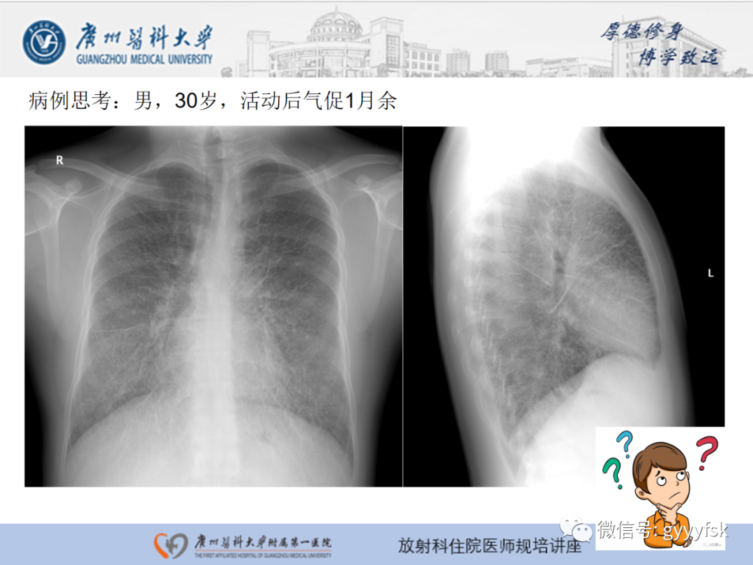 影像PPT - 【PPT】肺泡微石症阅片指导-2
