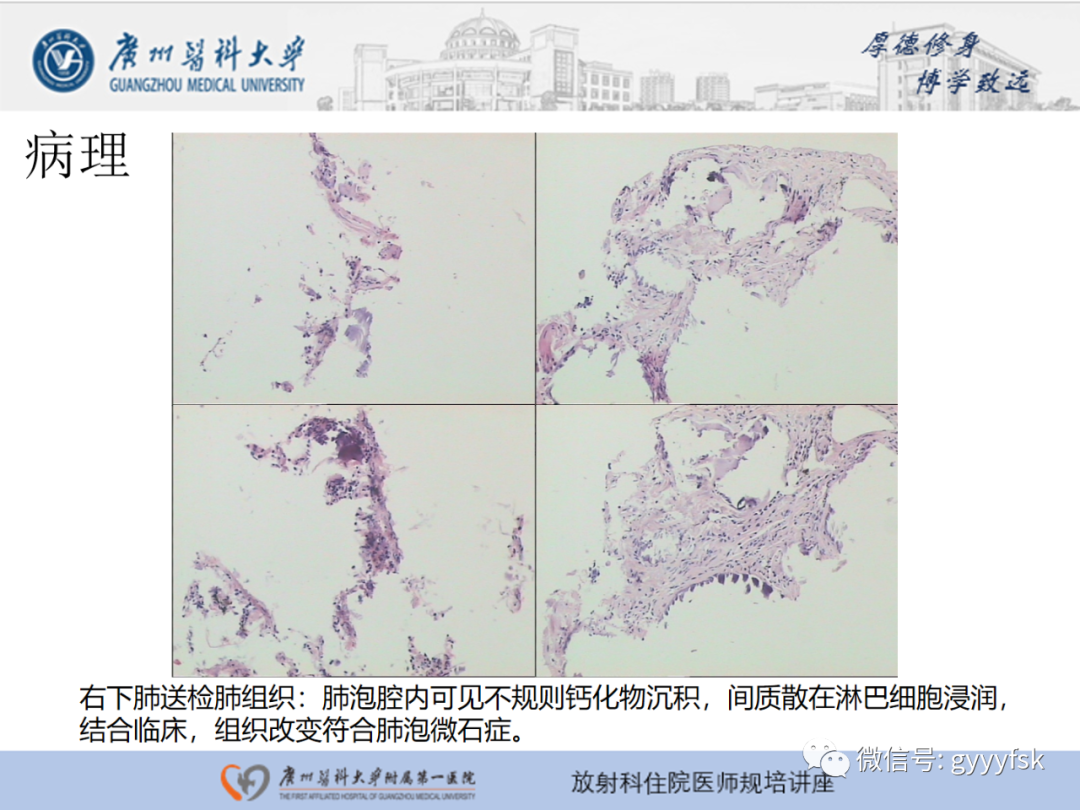 影像PPT - 【PPT】肺泡微石症阅片指导-7