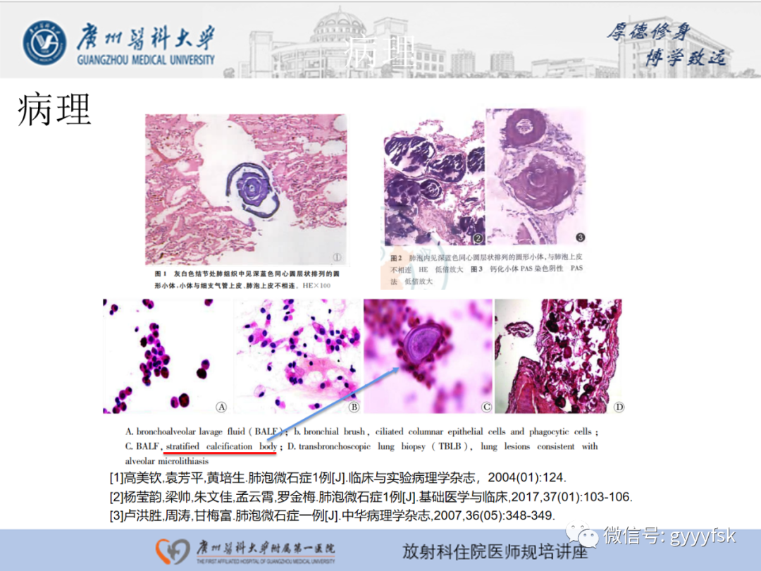 影像PPT - 【PPT】肺泡微石症阅片指导-8