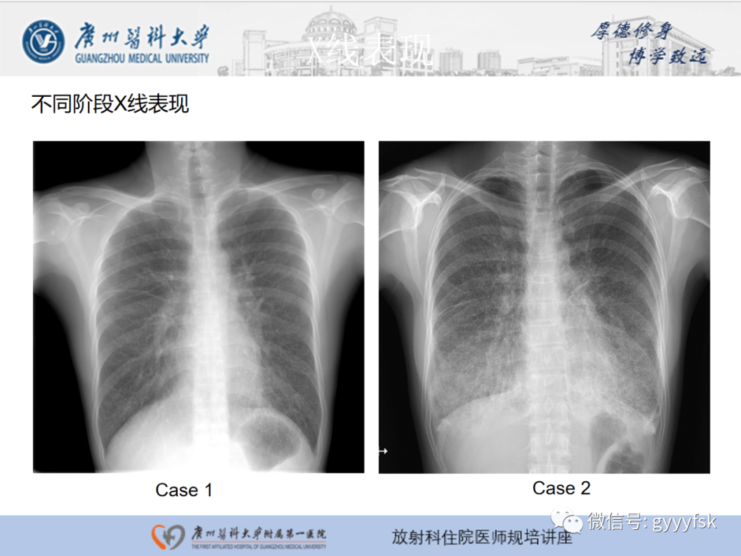 影像PPT - 【PPT】肺泡微石症阅片指导-12