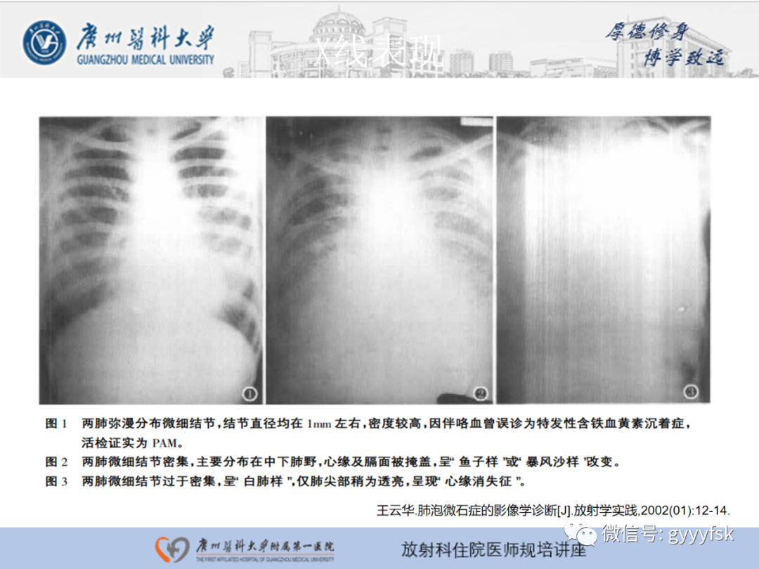 影像PPT - 【PPT】肺泡微石症阅片指导-13