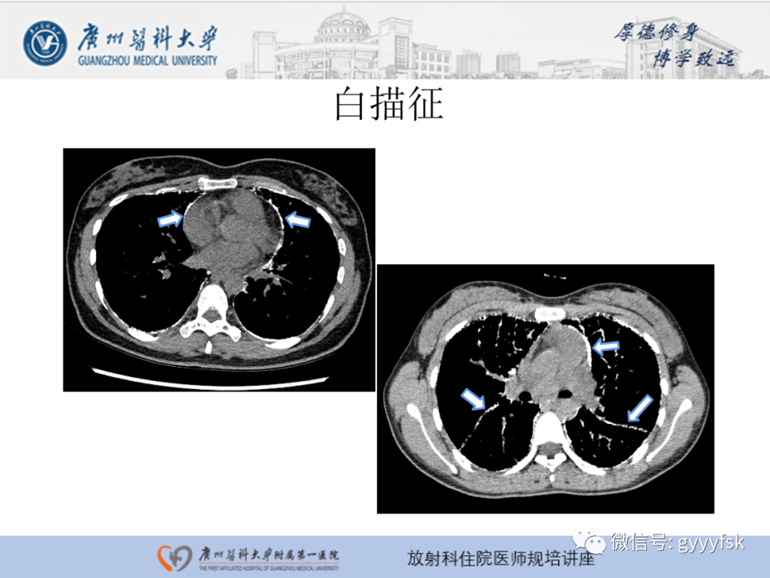 影像PPT - 【PPT】肺泡微石症阅片指导-16