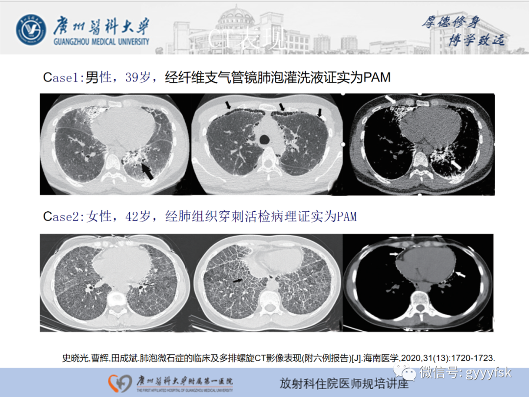 影像PPT - 【PPT】肺泡微石症阅片指导-15