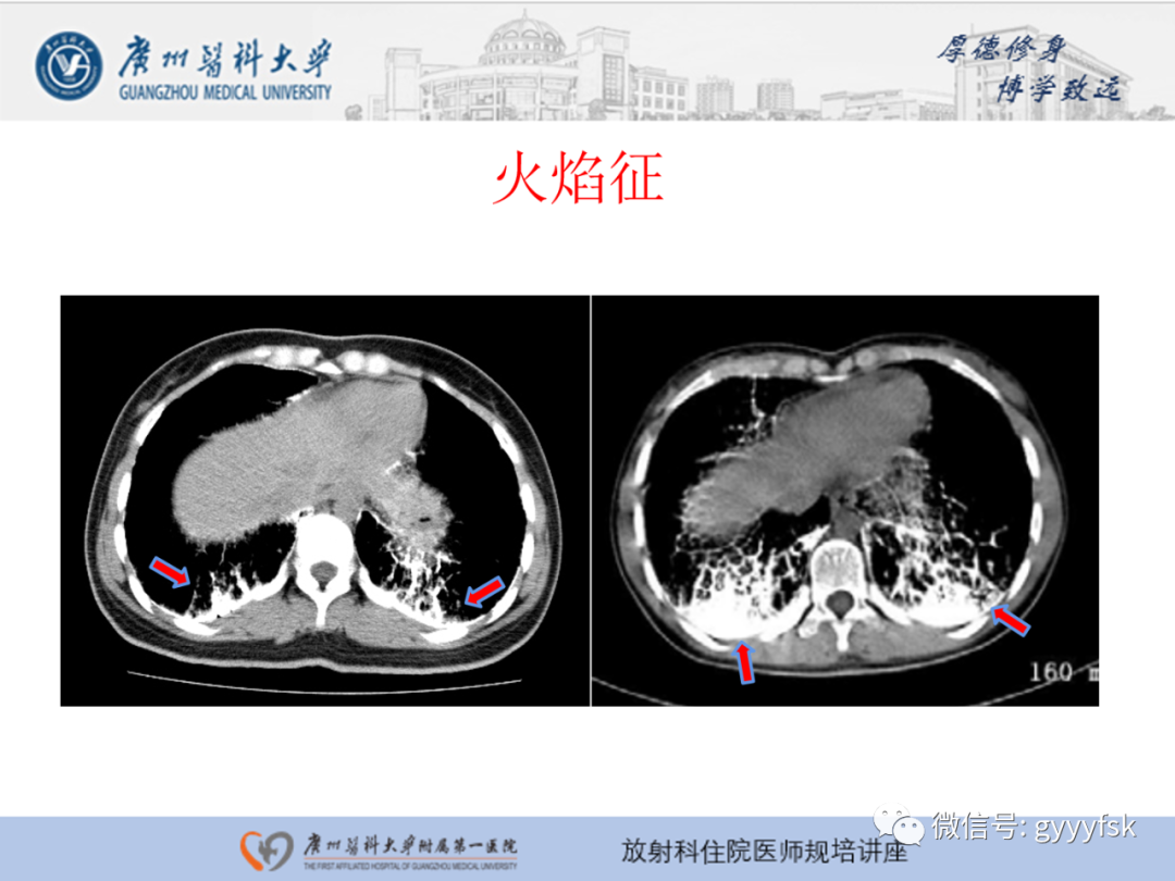 影像PPT - 【PPT】肺泡微石症阅片指导-17