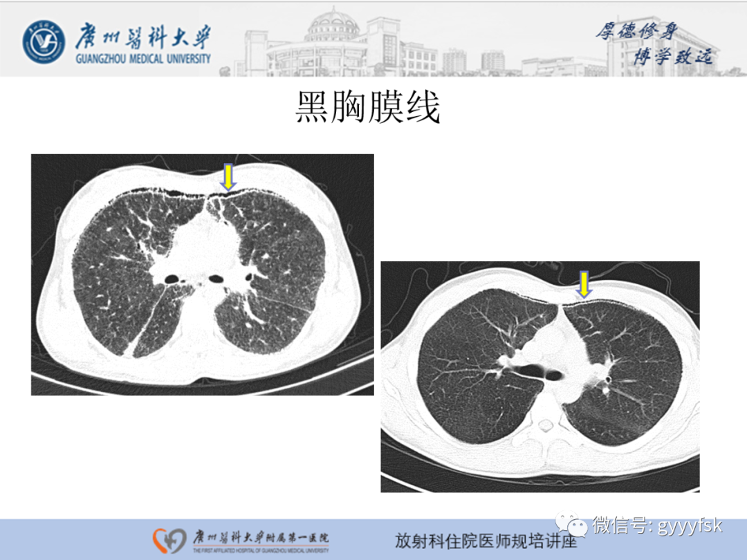 影像PPT - 【PPT】肺泡微石症阅片指导-18