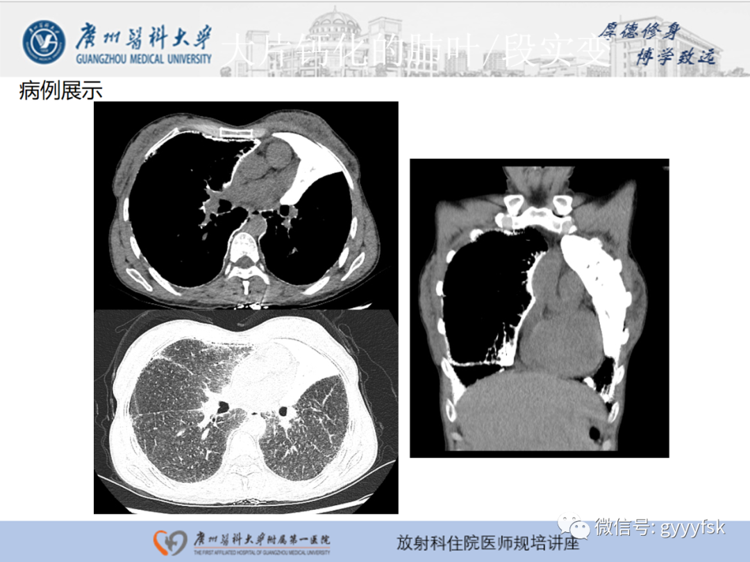 影像PPT - 【PPT】肺泡微石症阅片指导-20