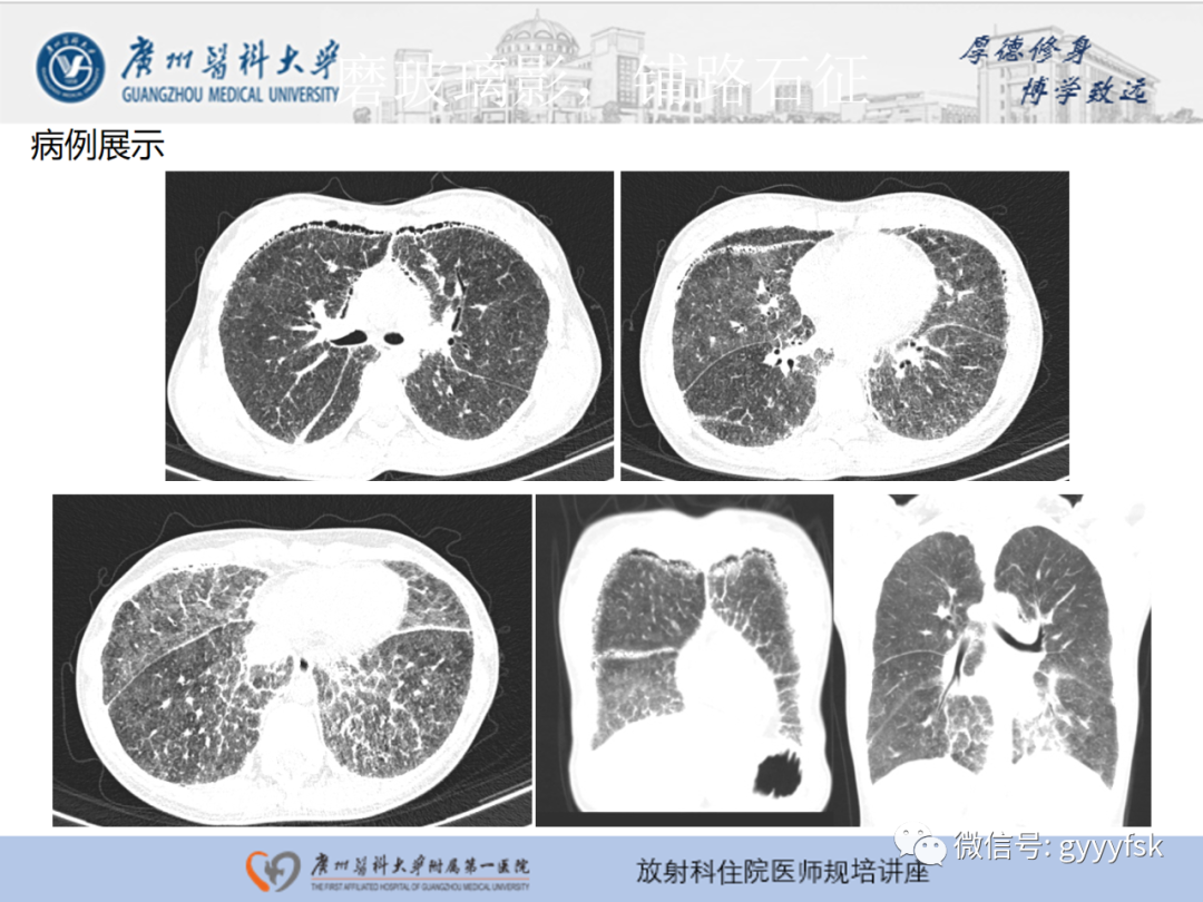 影像PPT - 【PPT】肺泡微石症阅片指导-19