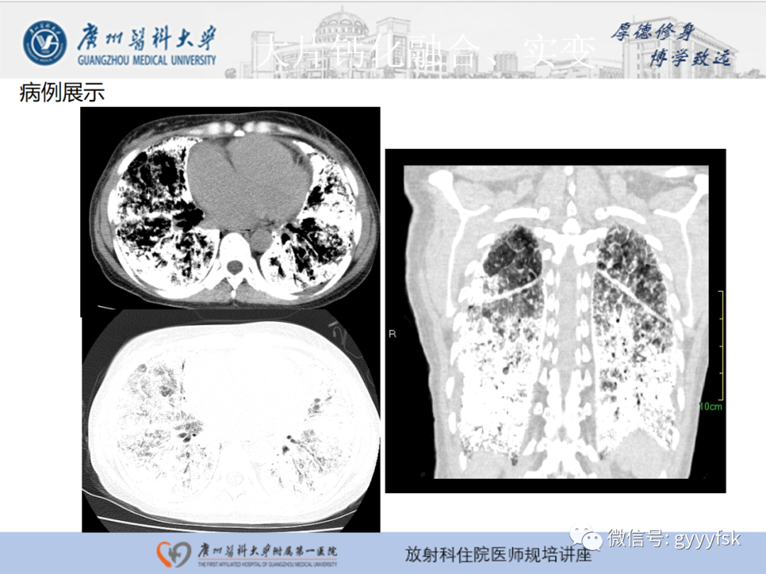 影像PPT - 【PPT】肺泡微石症阅片指导-21