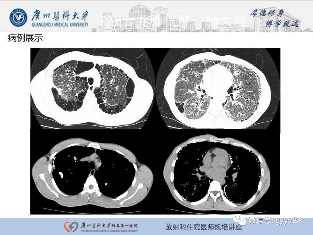 影像PPT - 【PPT】肺泡微石症阅片指导-22