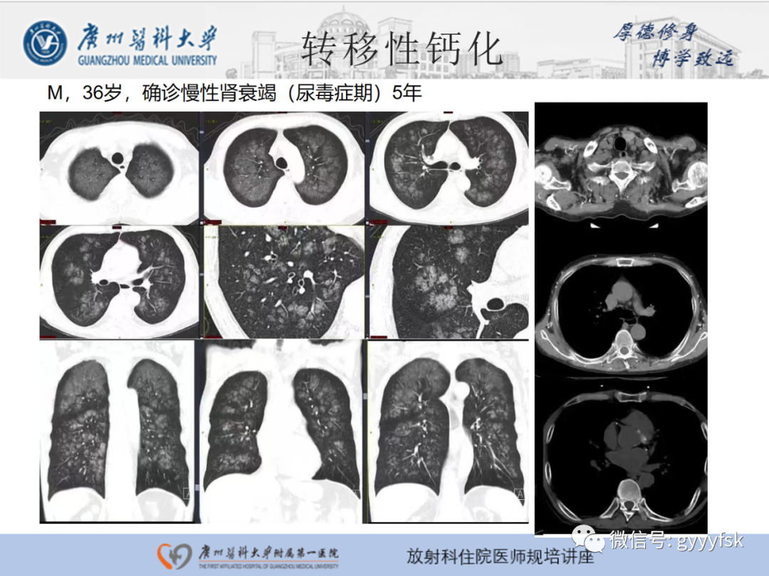影像PPT - 【PPT】肺泡微石症阅片指导-25