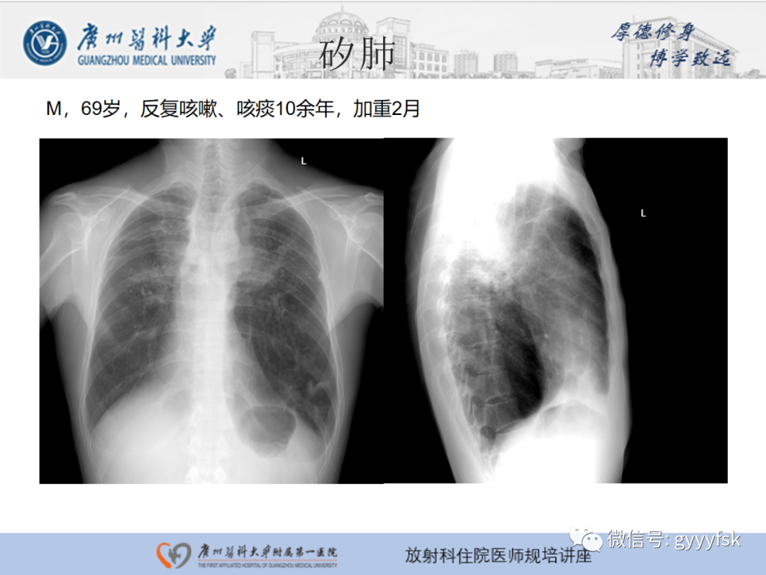 影像PPT - 【PPT】肺泡微石症阅片指导-27