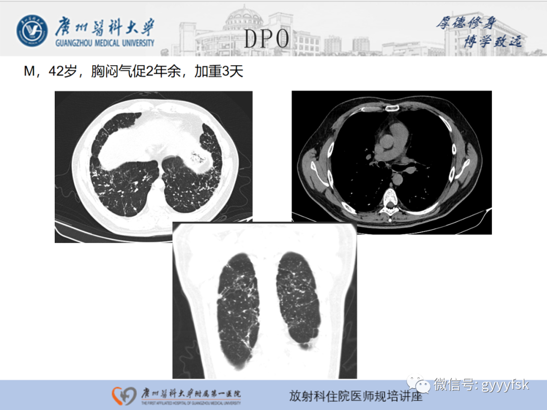 影像PPT - 【PPT】肺泡微石症阅片指导-29