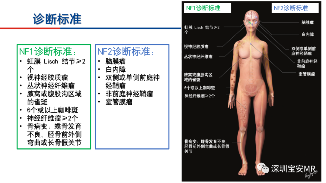 影像PPT - 【PPT】神经纤维瘤病诊断标准及相关影像学表现-8
