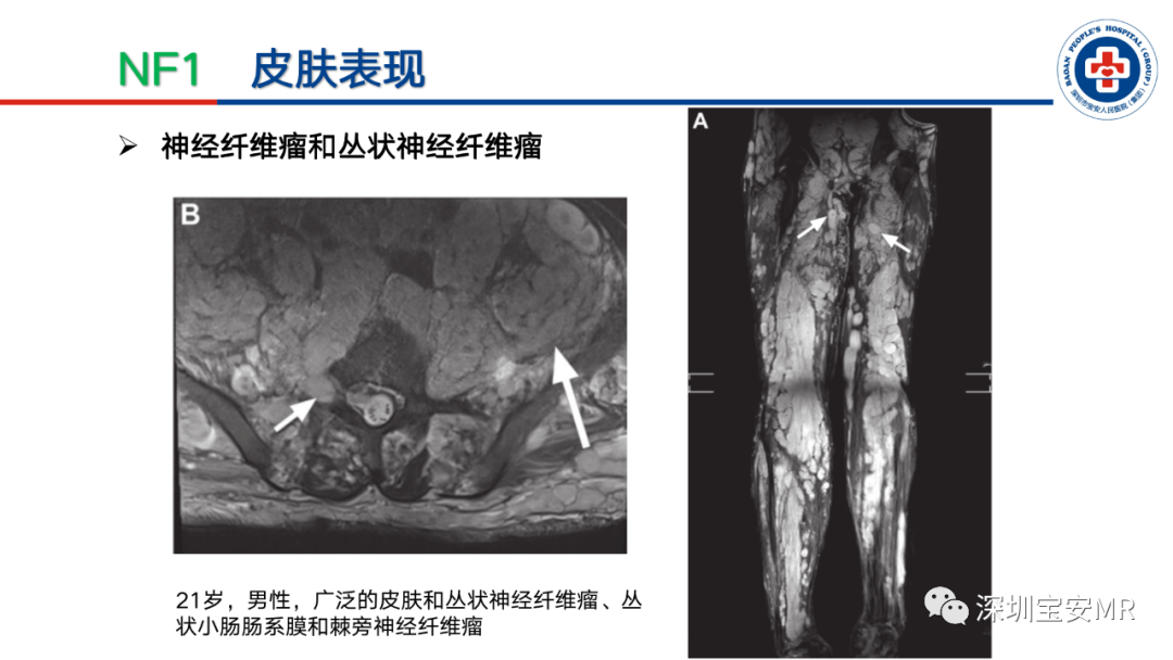 影像PPT - 【PPT】神经纤维瘤病诊断标准及相关影像学表现-12