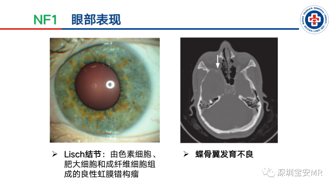 影像PPT - 【PPT】神经纤维瘤病诊断标准及相关影像学表现-13