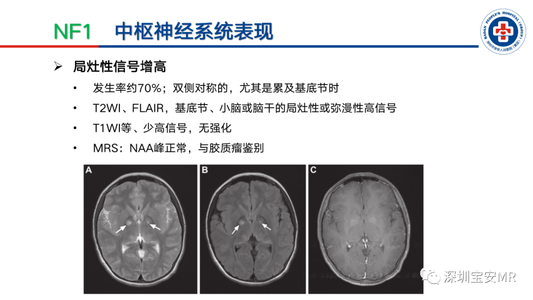 影像PPT - 【PPT】神经纤维瘤病诊断标准及相关影像学表现-16