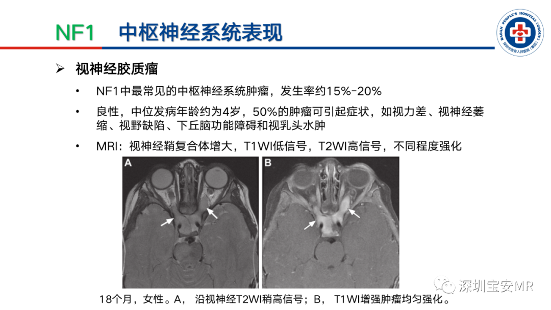 影像PPT - 【PPT】神经纤维瘤病诊断标准及相关影像学表现-17