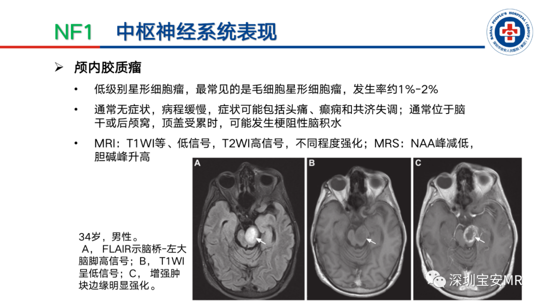 影像PPT - 【PPT】神经纤维瘤病诊断标准及相关影像学表现-18