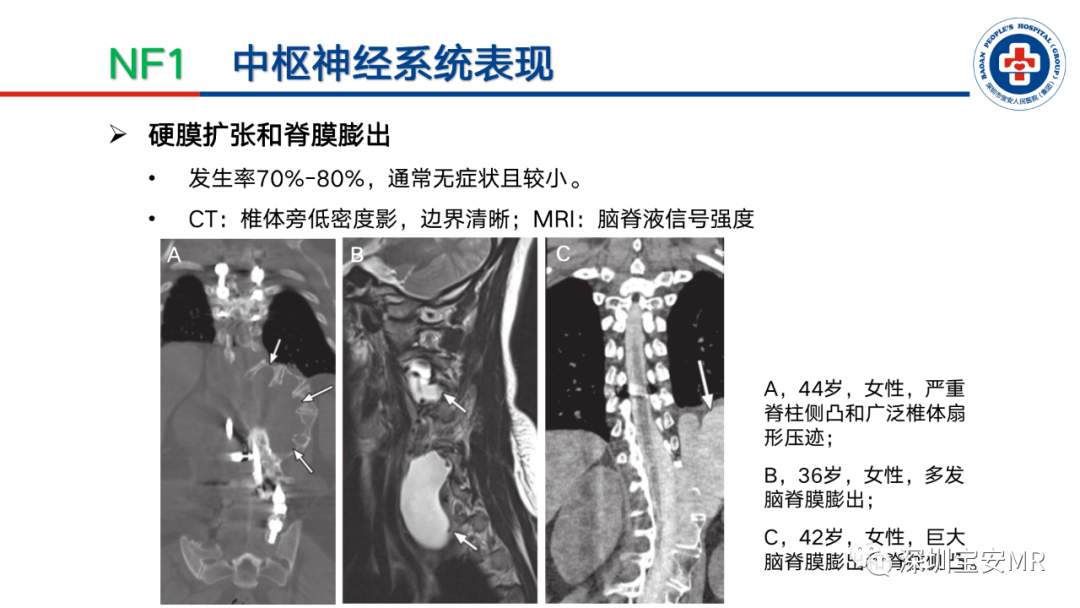 影像PPT - 【PPT】神经纤维瘤病诊断标准及相关影像学表现-19