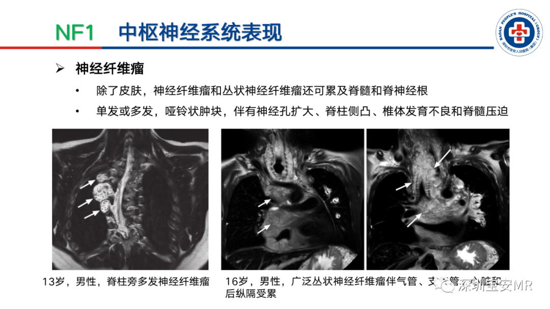 影像PPT - 【PPT】神经纤维瘤病诊断标准及相关影像学表现-20