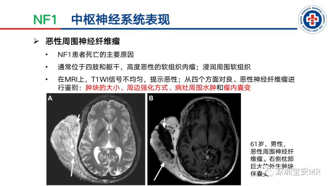 影像PPT - 【PPT】神经纤维瘤病诊断标准及相关影像学表现-21