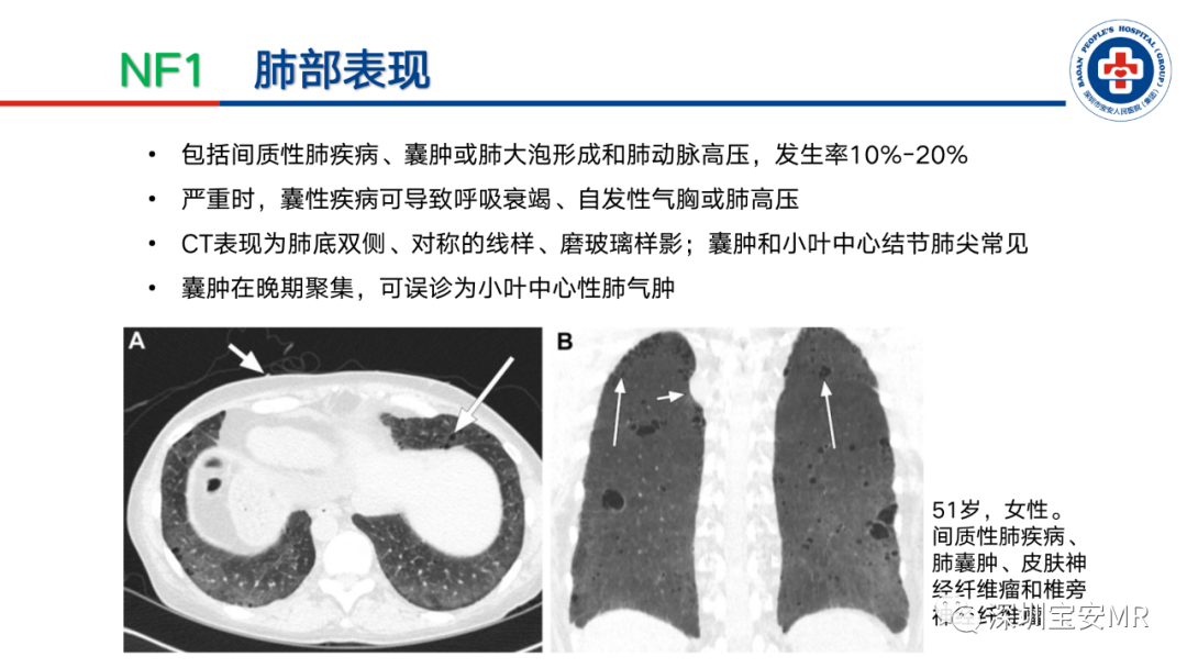 影像PPT - 【PPT】神经纤维瘤病诊断标准及相关影像学表现-22