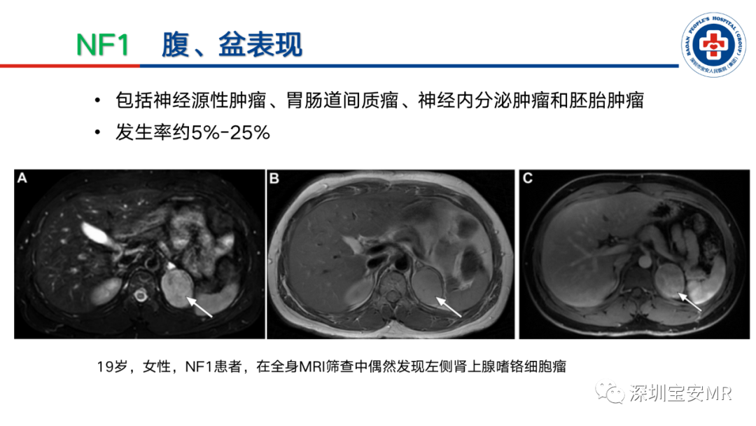 影像PPT - 【PPT】神经纤维瘤病诊断标准及相关影像学表现-24