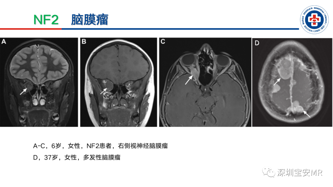 影像PPT - 【PPT】神经纤维瘤病诊断标准及相关影像学表现-30