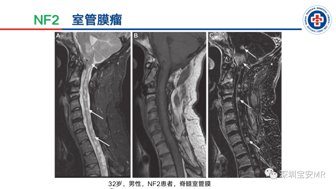 影像PPT - 【PPT】神经纤维瘤病诊断标准及相关影像学表现-31