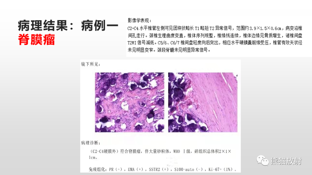 影像PPT - 【病例】脊膜瘤2例MR影像-8