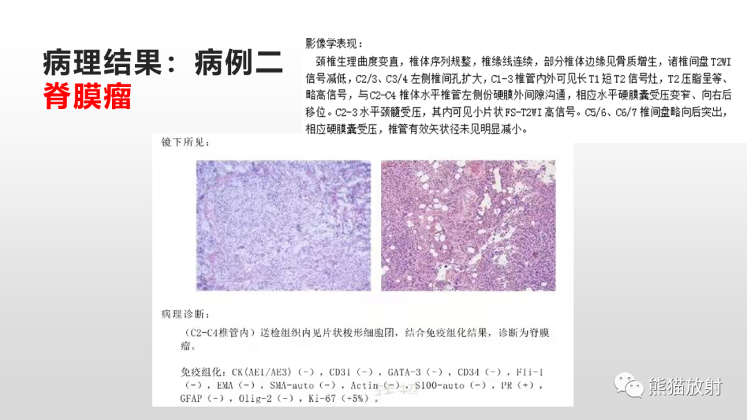 影像PPT - 【病例】脊膜瘤2例MR影像-9