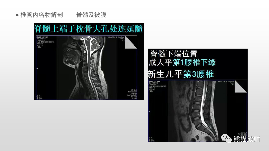 影像PPT - 【病例】脊膜瘤2例MR影像-11