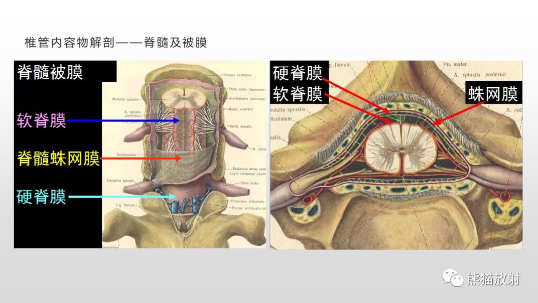 影像PPT - 【病例】脊膜瘤2例MR影像-12