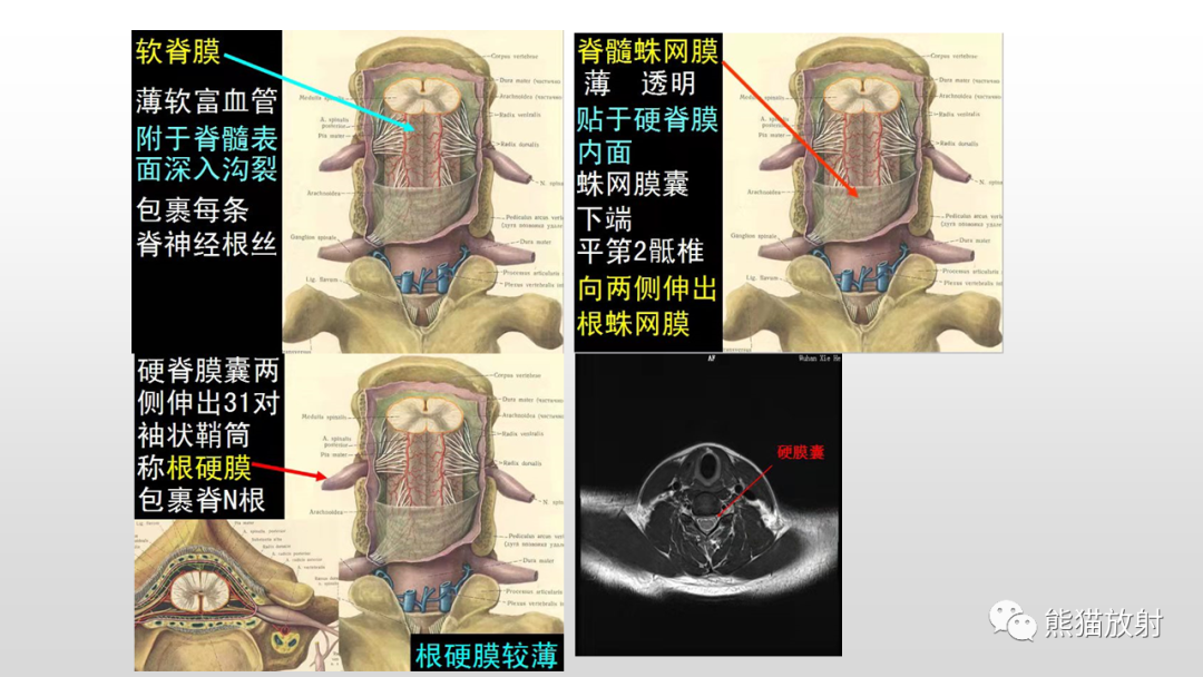 影像PPT - 【病例】脊膜瘤2例MR影像-13
