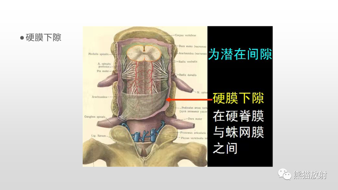 影像PPT - 【病例】脊膜瘤2例MR影像-15