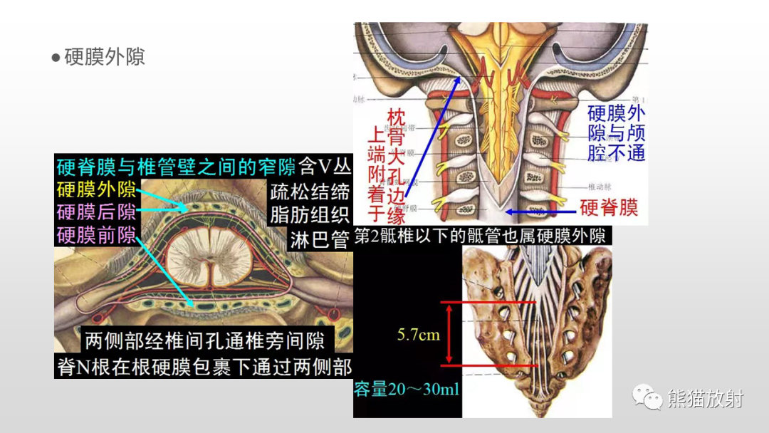 影像PPT - 【病例】脊膜瘤2例MR影像-16