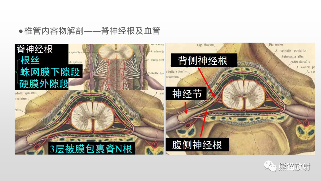 影像PPT - 【病例】脊膜瘤2例MR影像-17