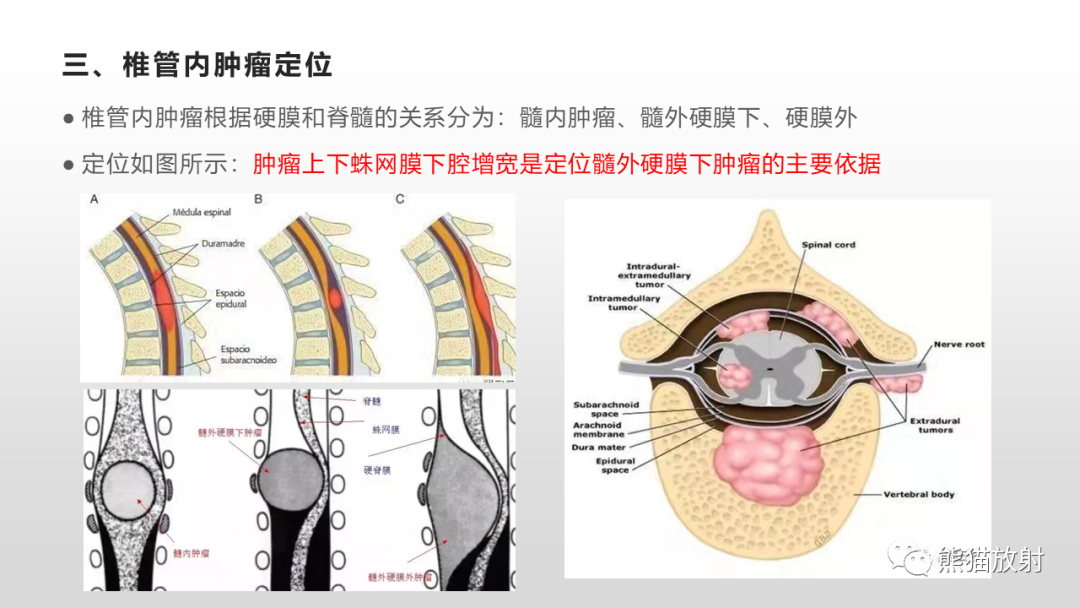 影像PPT - 【病例】脊膜瘤2例MR影像-20