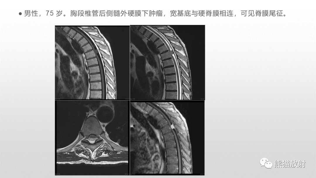 影像PPT - 【病例】脊膜瘤2例MR影像-25