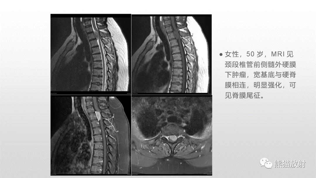 影像PPT - 【病例】脊膜瘤2例MR影像-26