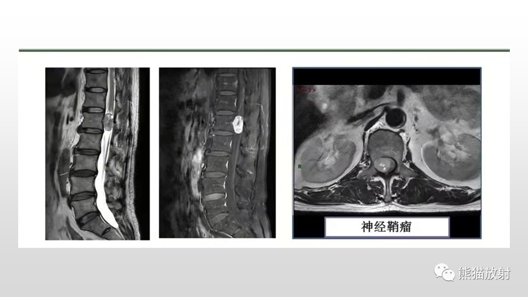 影像PPT - 【病例】脊膜瘤2例MR影像-30