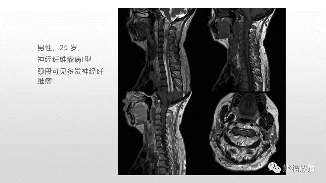 影像PPT - 【病例】脊膜瘤2例MR影像-35