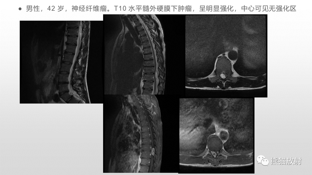 影像PPT - 【病例】脊膜瘤2例MR影像-1