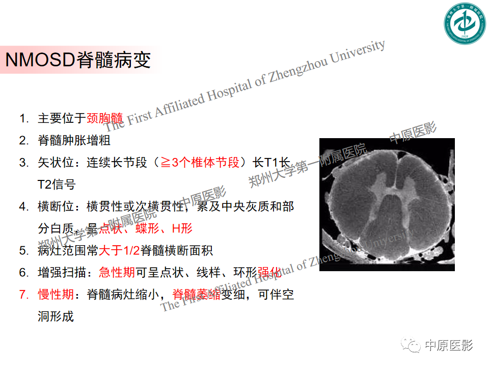 影像PPT - 【PPT】视神经脊髓炎与多发性硬化鉴别诊断-5