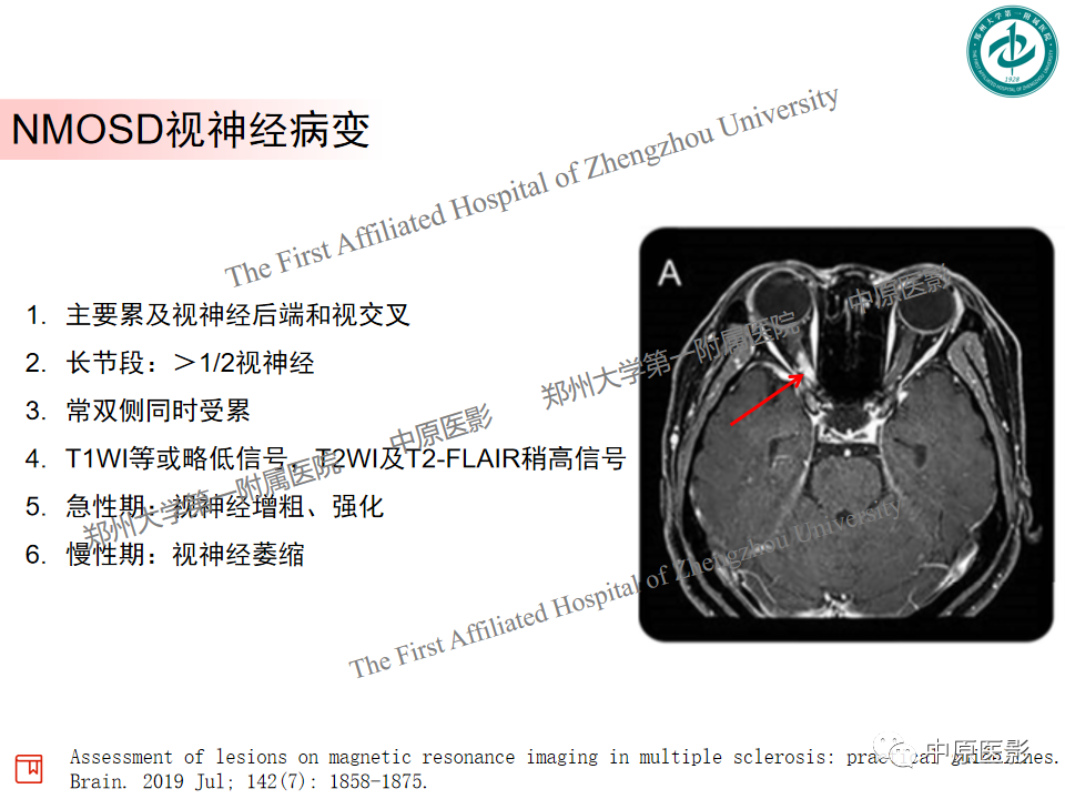 影像PPT - 【PPT】视神经脊髓炎与多发性硬化鉴别诊断-7